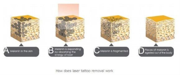 Система удаления татуировки лазера yag nd переключателя клиники профессиональная q с большим промотированием