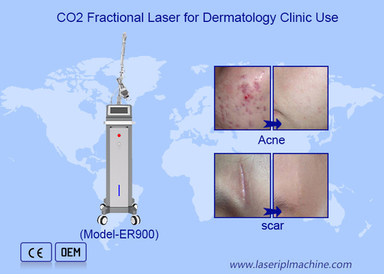 Удаление кровеносных сосудов 10600 нм Лазерная очистка кожи